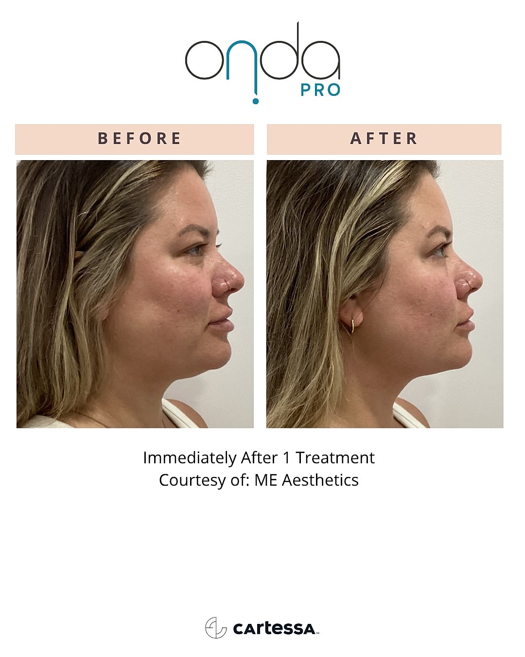 Before and after results of aesthetic treatment