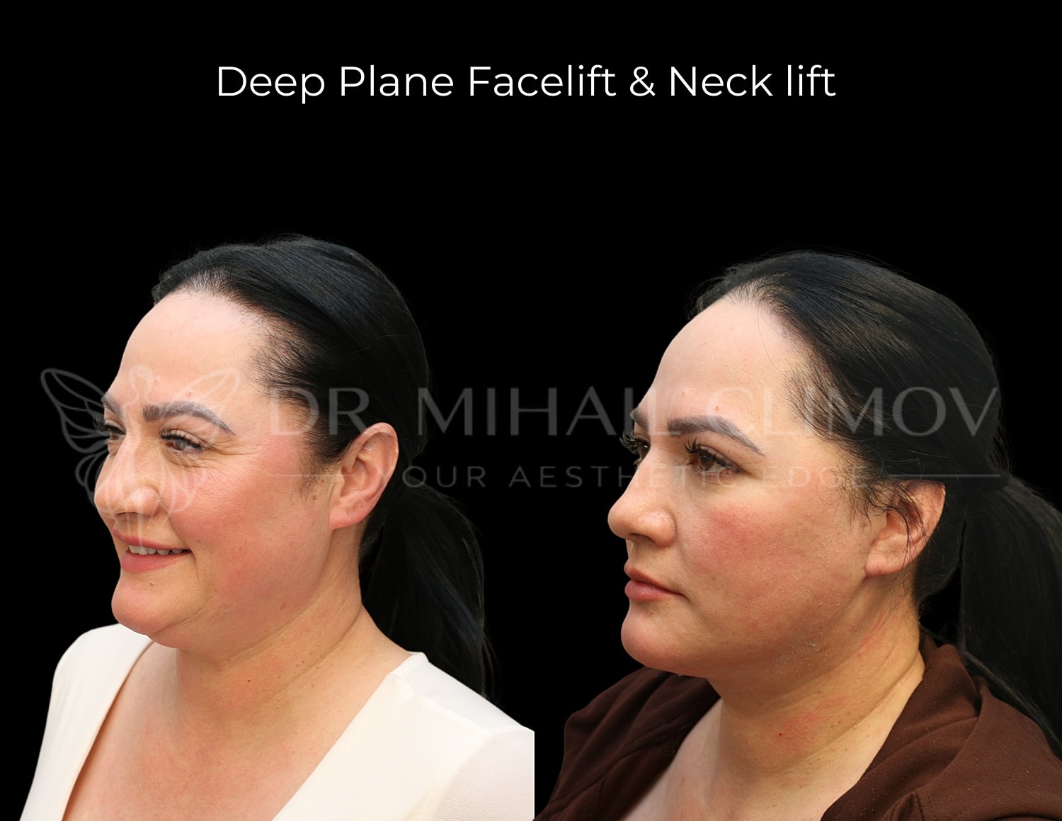Before and after deep plane facelift and neck lift