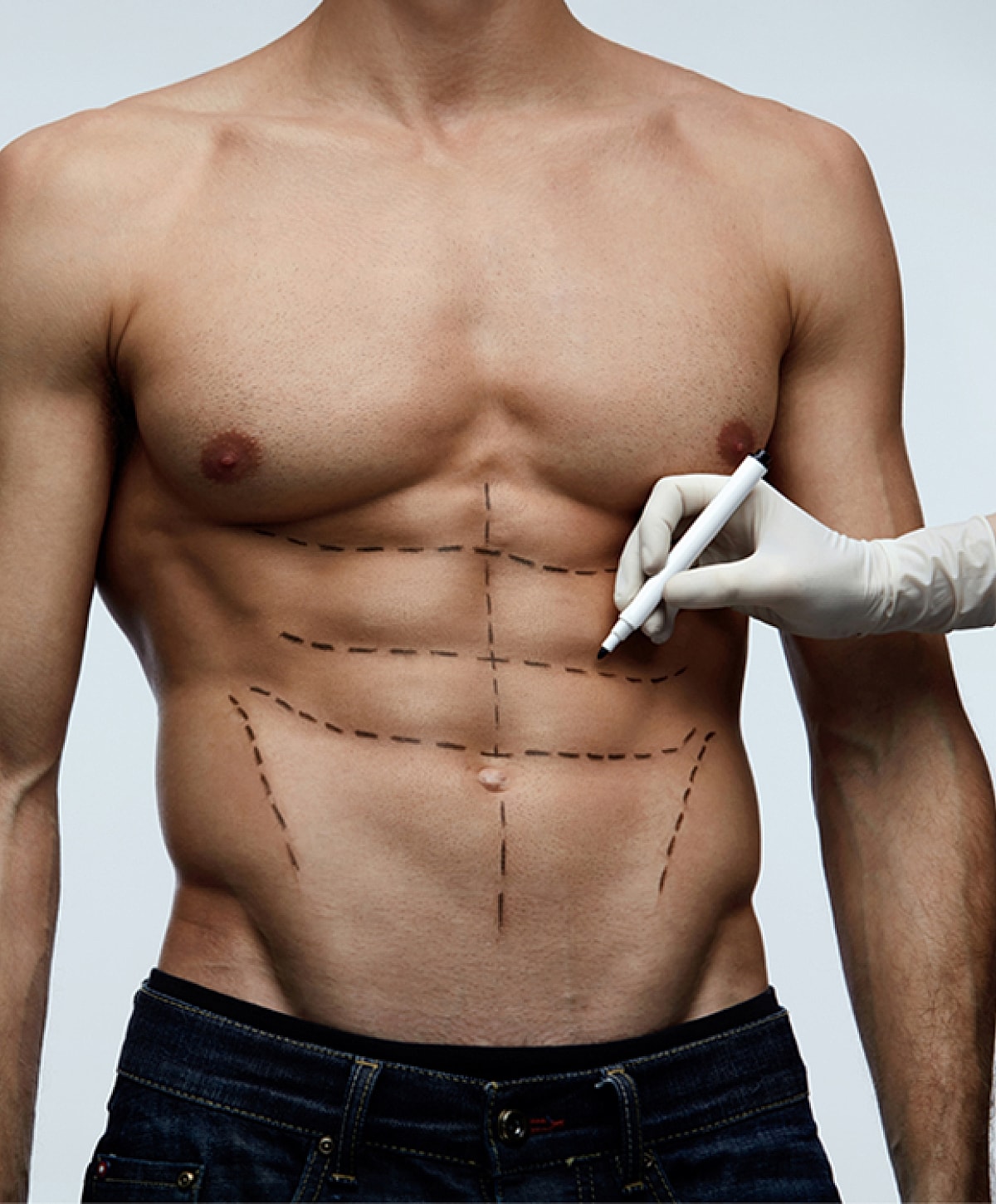 Markings on male abdomen for surgical planning