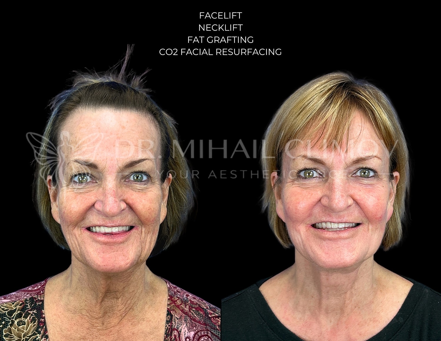 Before and after facial cosmetic procedures results