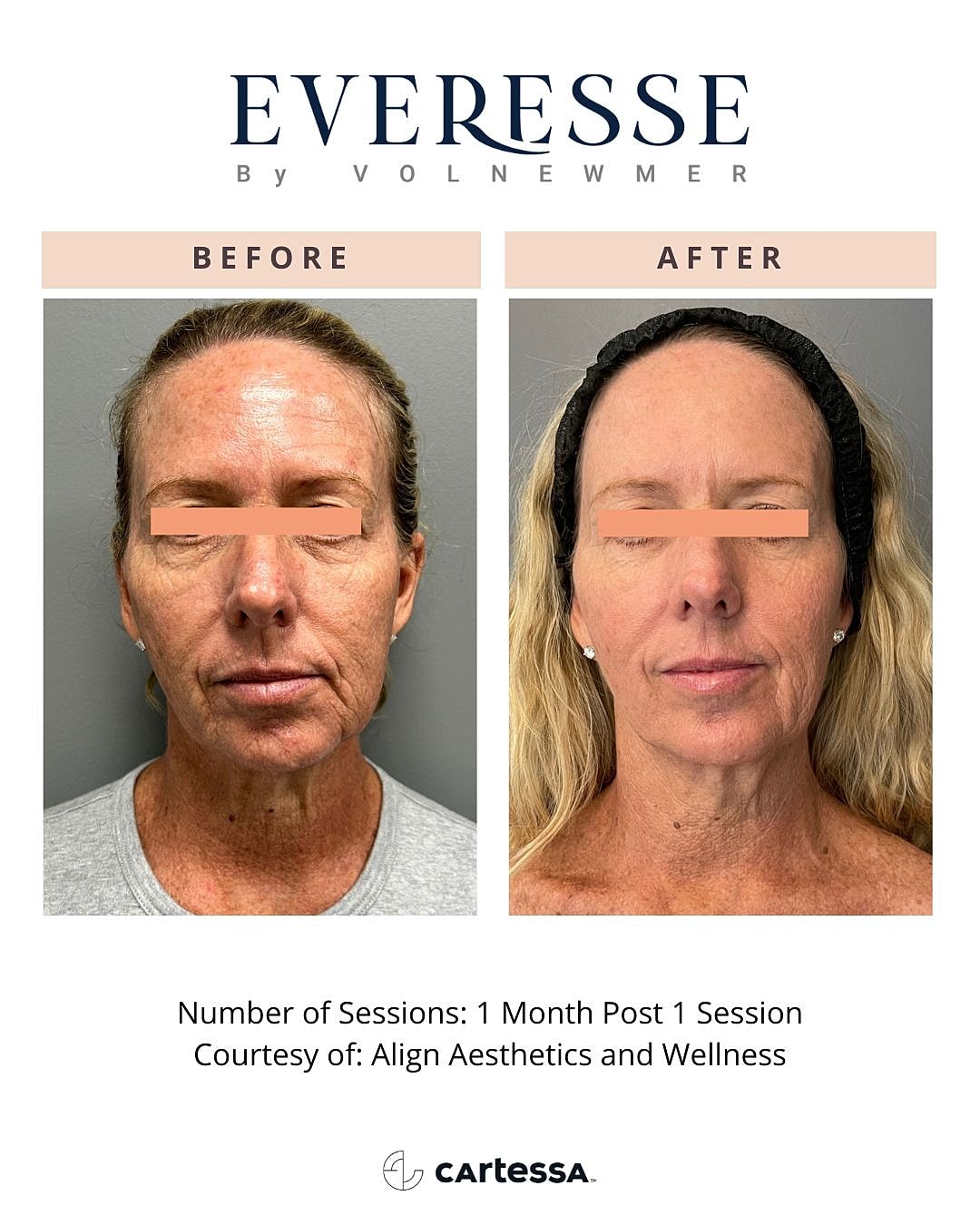 Facial rejuvenation before and after treatment.