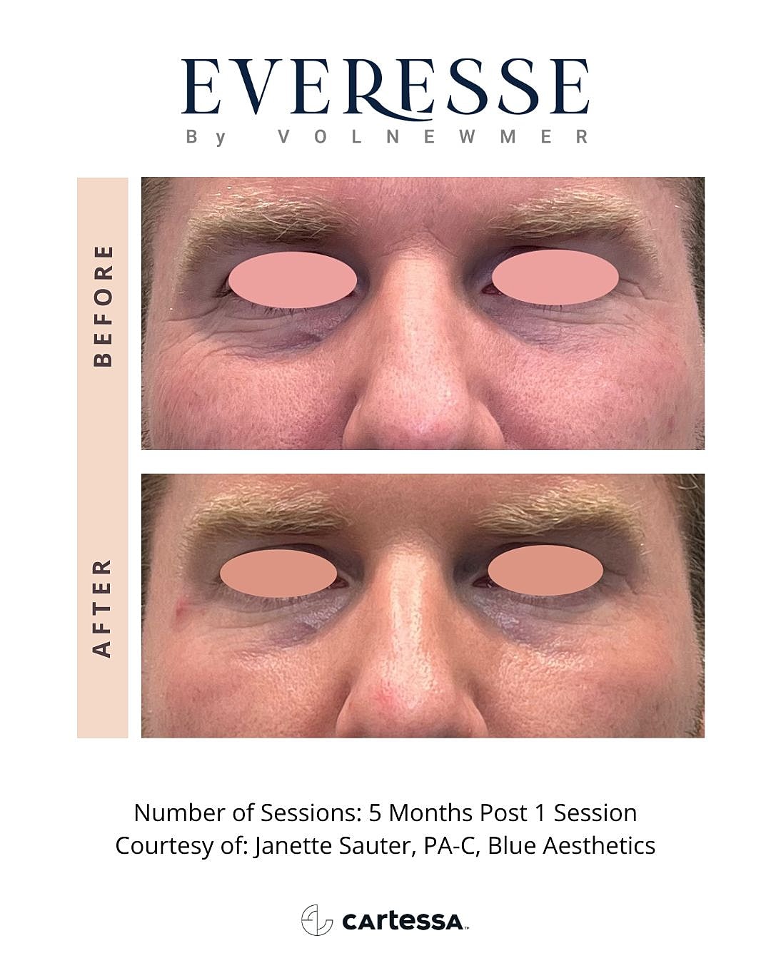 Before and after of skincare treatment results