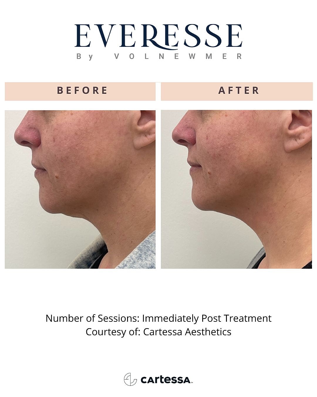 Before and after aesthetic treatment comparison image.