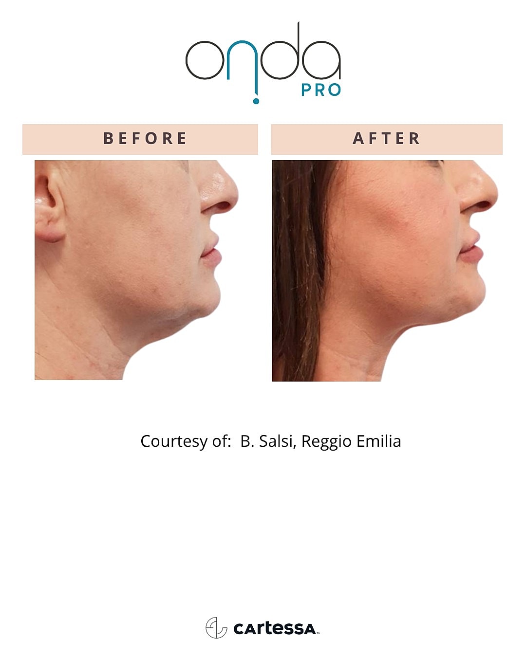 Before and after Onda Pro treatment comparison