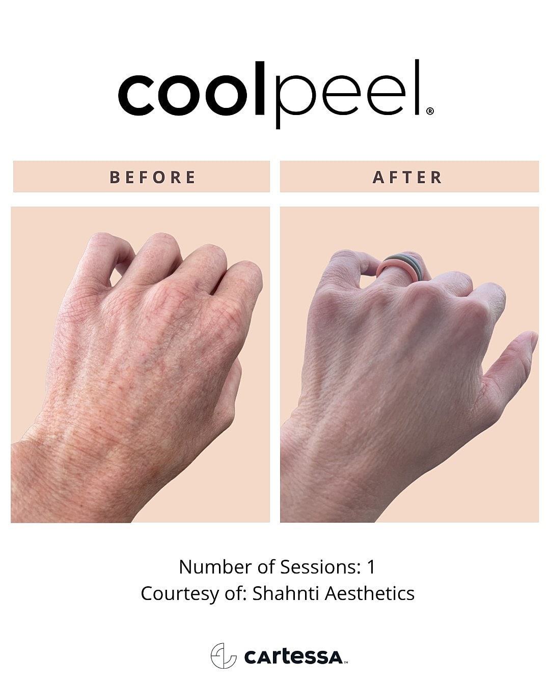 Before and after CoolPeel skin treatment results.