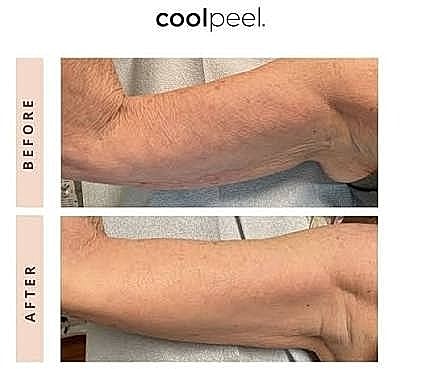 CoolPeel treatment before and after on arm.
