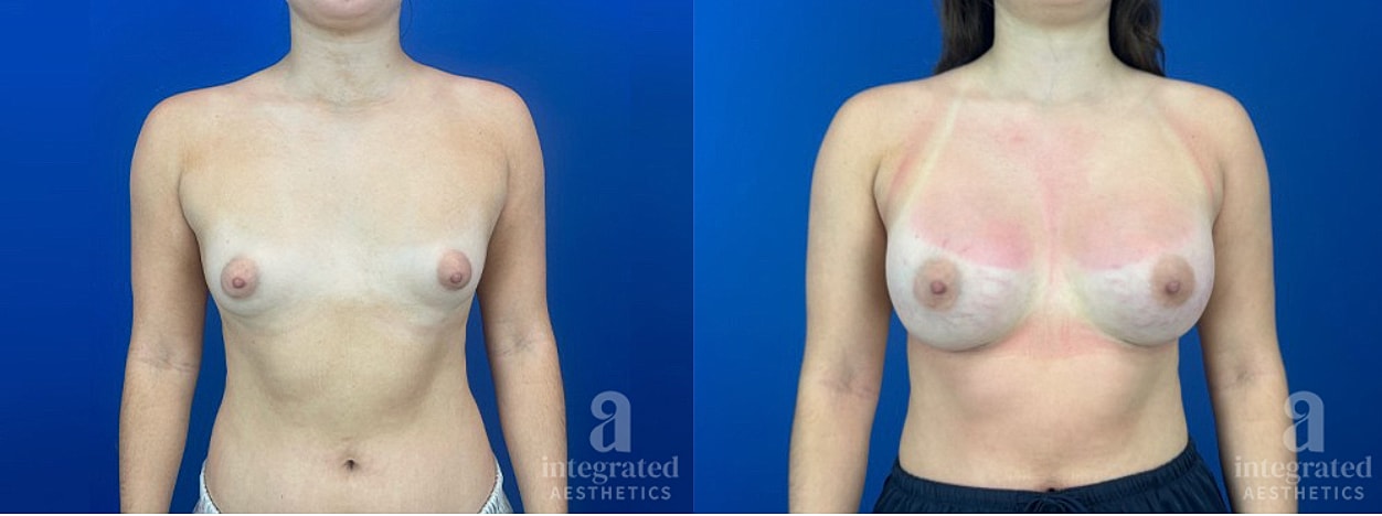 Before and after breast augmentation comparison.