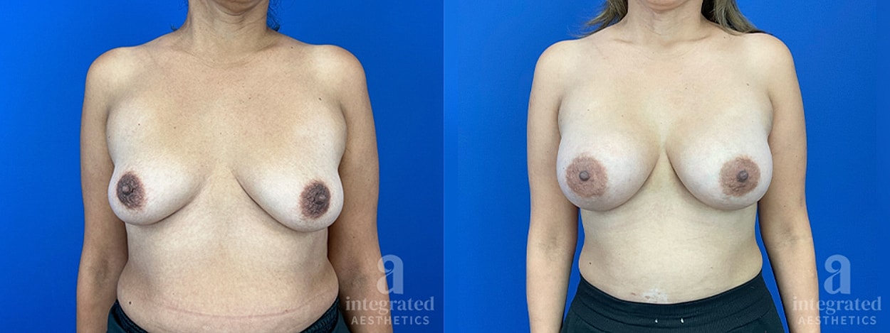 Before and after breast augmentation results.