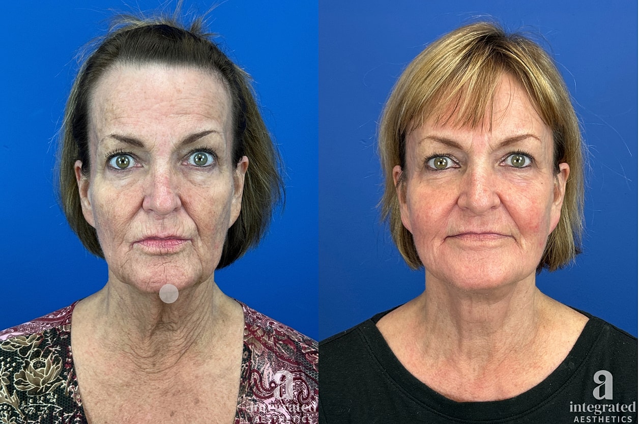 Before and after portrait of facial rejuvenation.