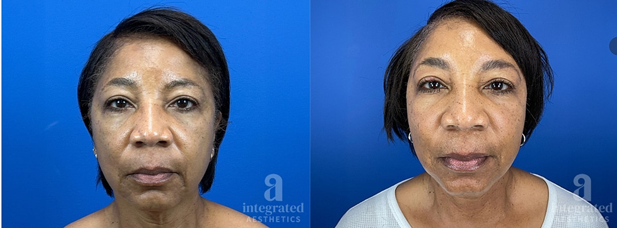 Before and after facial treatment comparison.