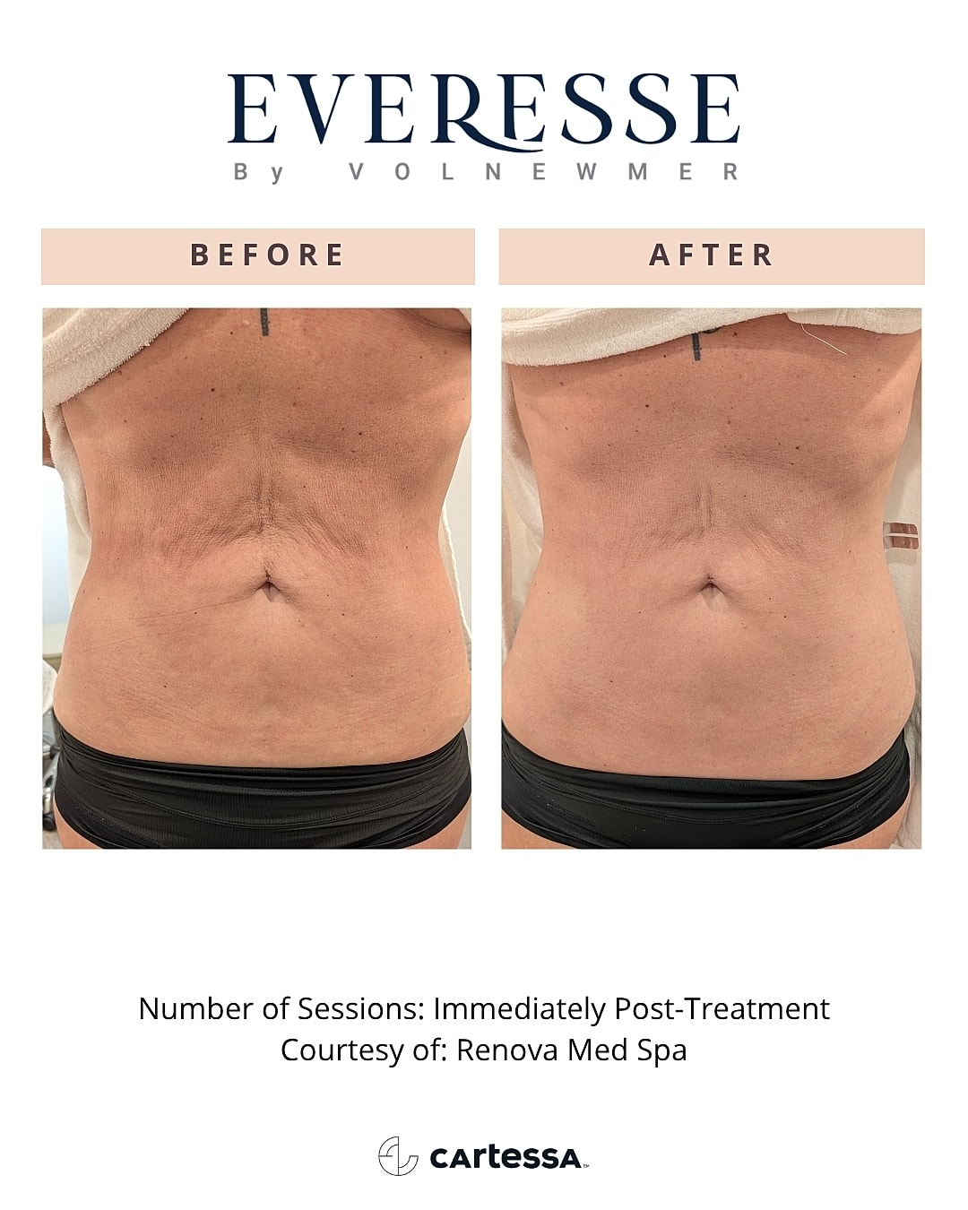 Skin treatment before and after comparison image.