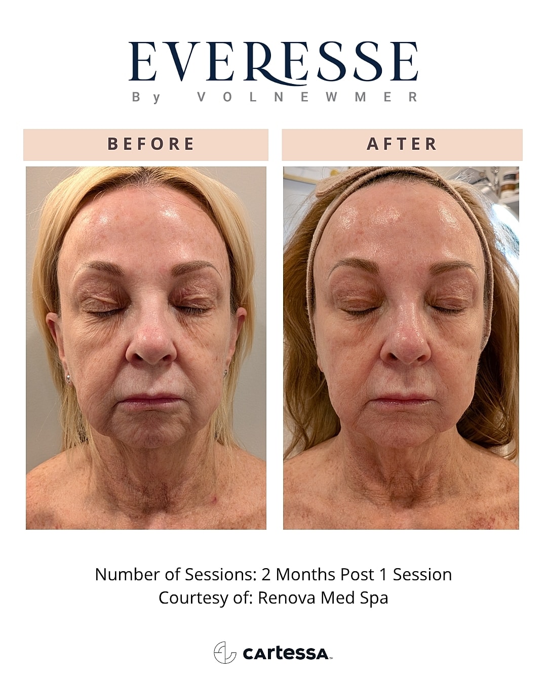 Before and after facial treatment comparison.