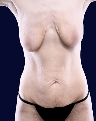 Breast Augmentation Before & After