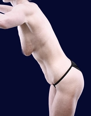 Breast Augmentation Before & After