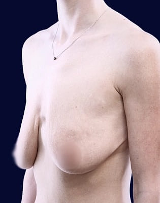 Breast Augmentation Before & After