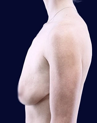 Breast Augmentation Before & After