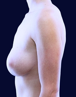 Breast Augmentation Before & After