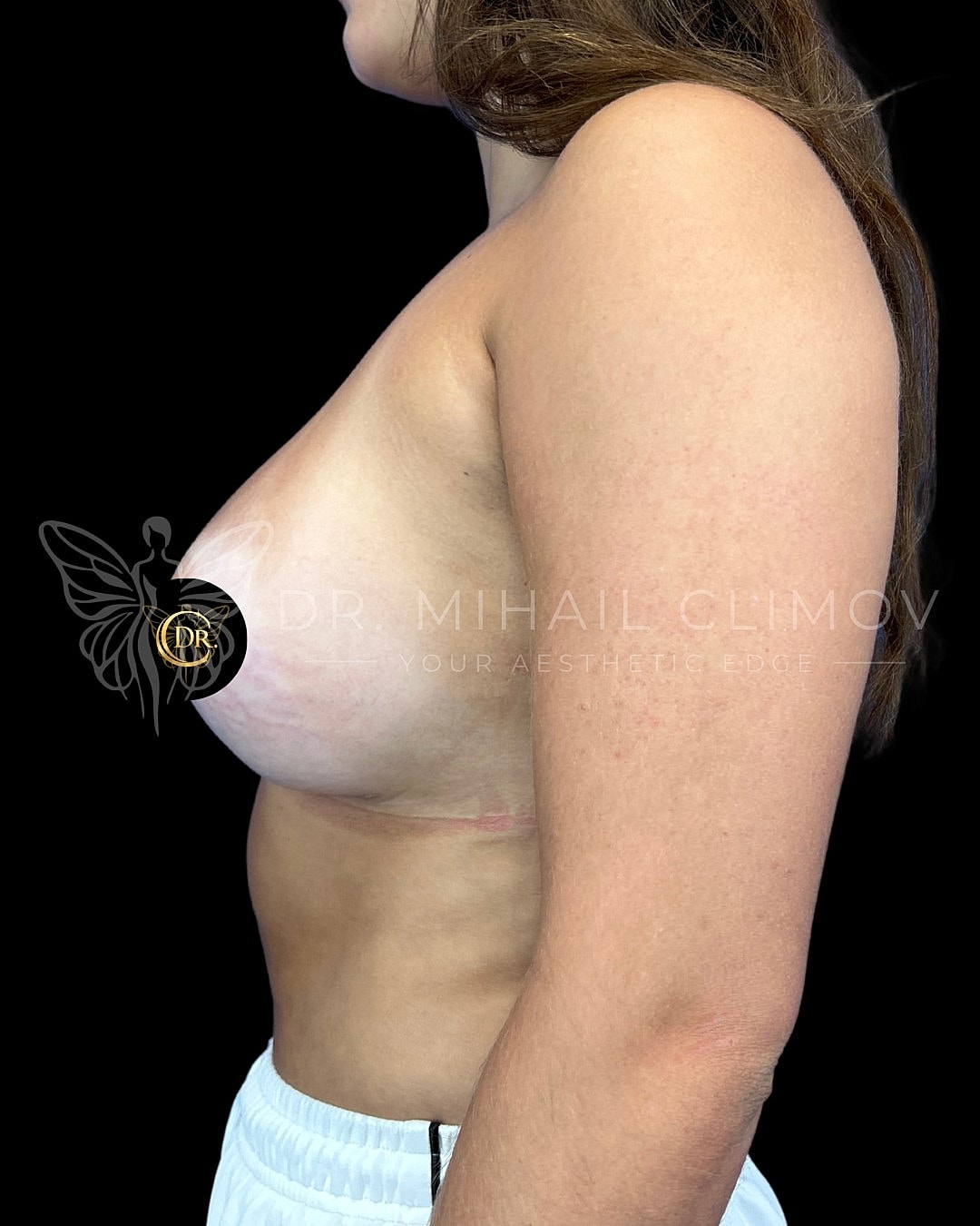 Case_003_after_left.png After breast augmentation results – left side profile view – Dr. Mihail Climov, Aesthetic Plastic Surgeon, Houston, TX