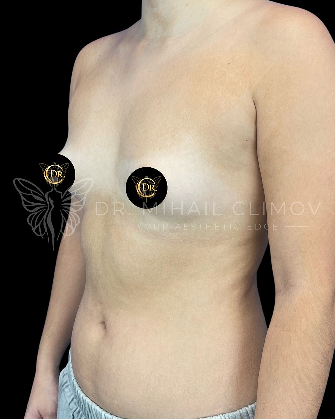 Case_003_Before_left_3_4.png Before breast augmentation surgery – left 3/4 angle view – Dr. Mihail Climov, Aesthetic Plastic Surgeon, Houston, TX