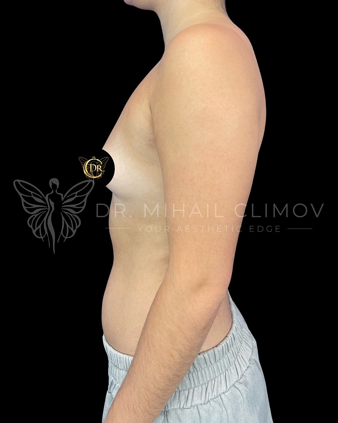 ase_003_Before_left.png Before breast augmentation surgery – left side profile view – Dr. Mihail Climov, Aesthetic Plastic Surgeon, Houston, TX