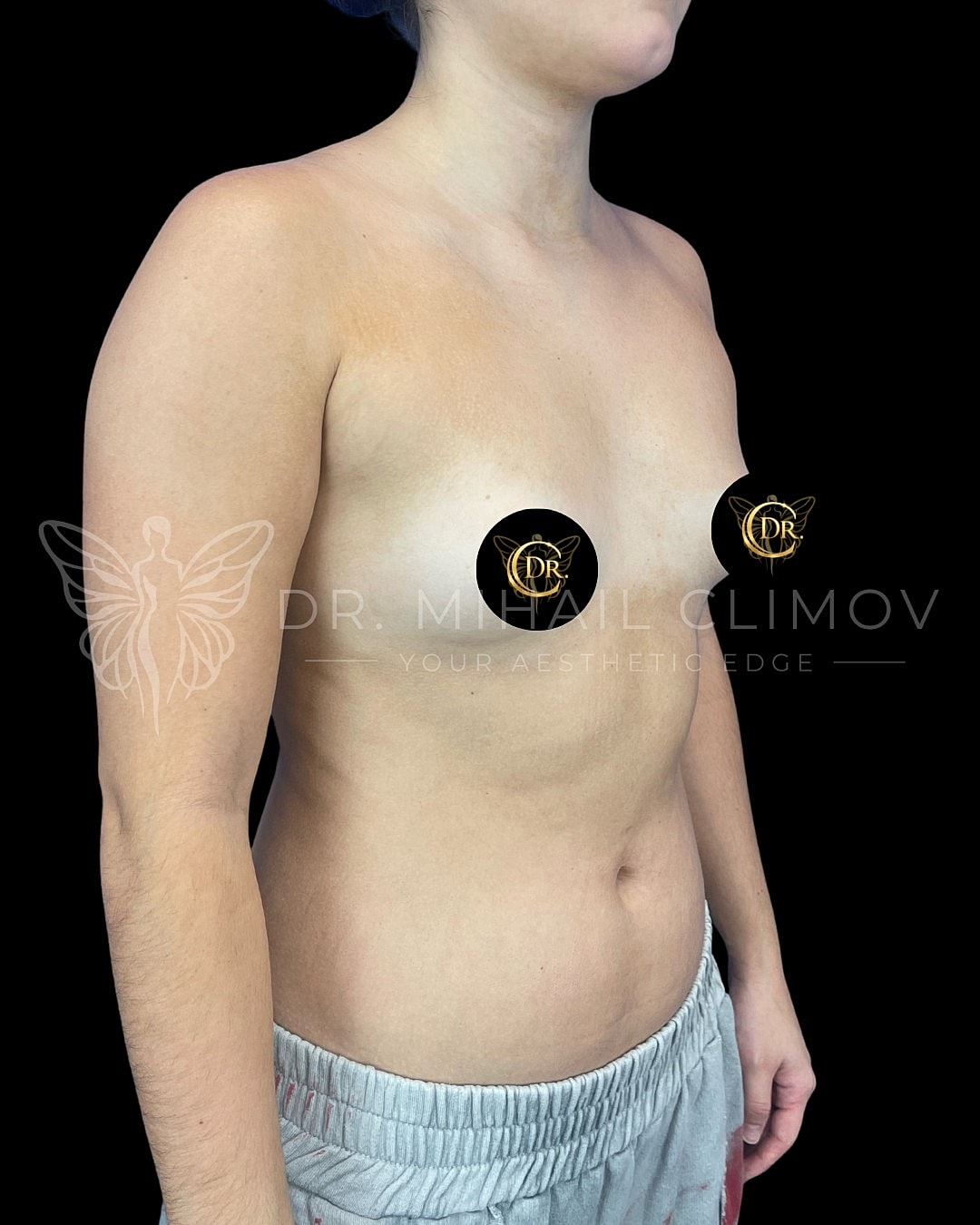 Case_003_Before_right_3_4.png Before breast augmentation surgery – right 3/4 angle view – Dr. Mihail Climov, Aesthetic Plastic Surgeon, Houston, TX