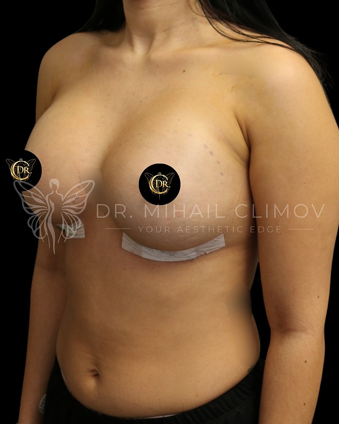Case_004_left_3_4_after.png After breast augmentation results – left 3/4 angle view – Dr. Mihail Climov, Aesthetic Plastic Surgeon, Houston, TX