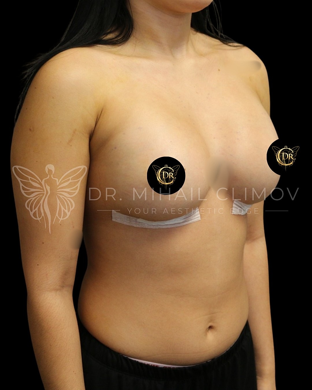 Case_004_right_3_4_after.png After breast augmentation results – right 3/4 angle view – Dr. Mihail Climov, Aesthetic Plastic Surgeon, Houston, TX