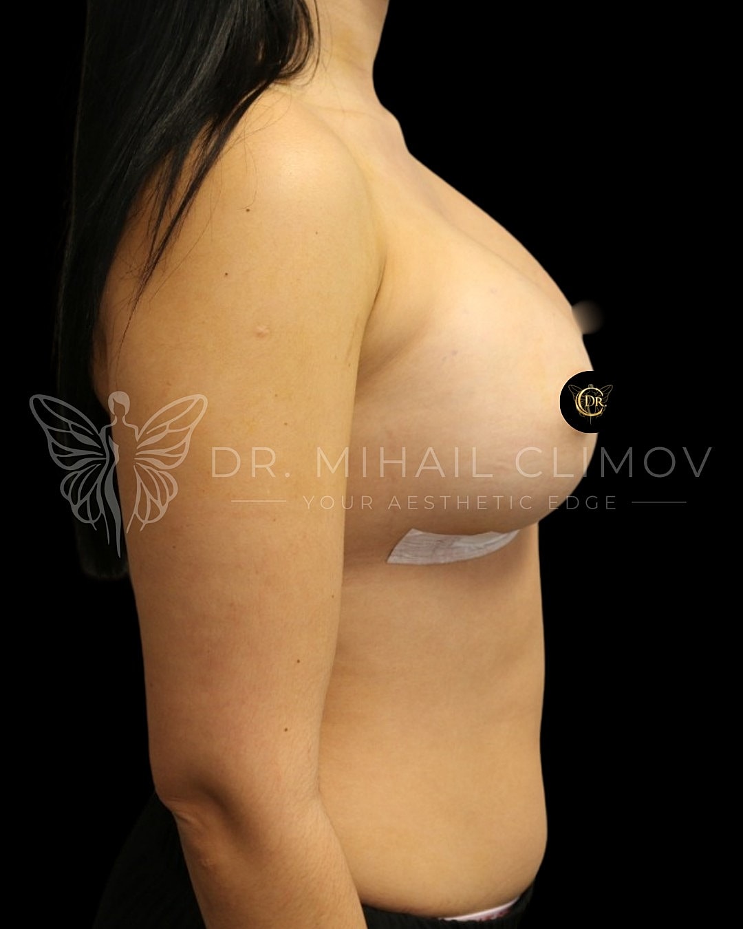 Case_004_right_after.png After breast augmentation results – right side profile view – Dr. Mihail Climov, Aesthetic Plastic Surgeon, Houston, TX