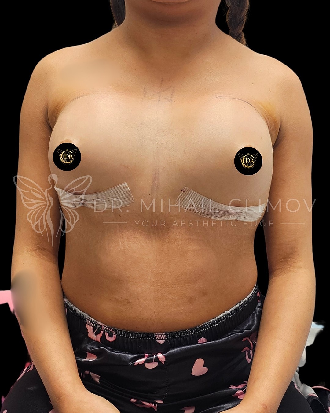Case_3-11-26_after_front.png After breast augmentation results – front view – Dr. Mihail Climov, Aesthetic Plastic Surgeon, Houston, TX
