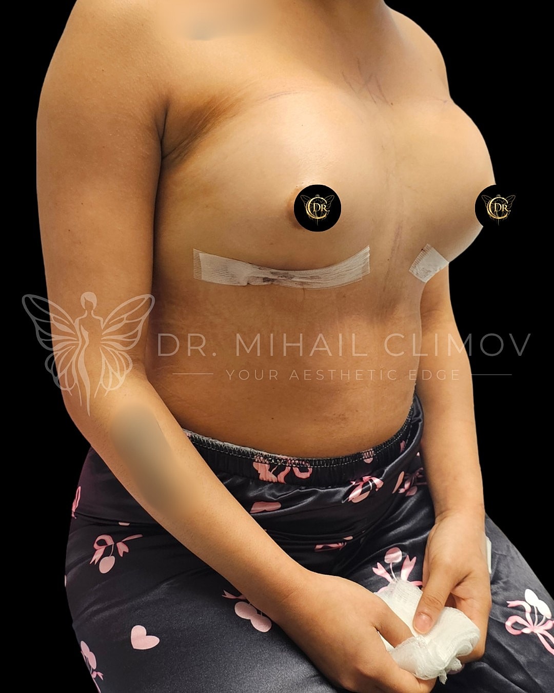 Case_3-11-26_after_right_3_4.png After breast augmentation results – right 3/4 angle view – Dr. Mihail Climov, Aesthetic Plastic Surgeon, Houston, TX