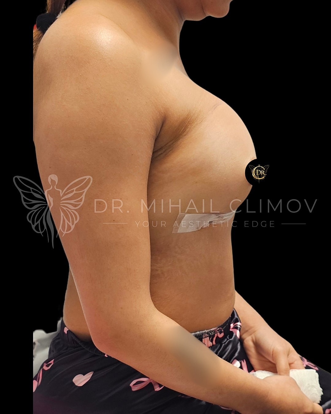 Case_3-11-26_After_right.png After breast augmentation results – right side profile view – Dr. Mihail Climov, Aesthetic Plastic Surgeon, Houston, TX