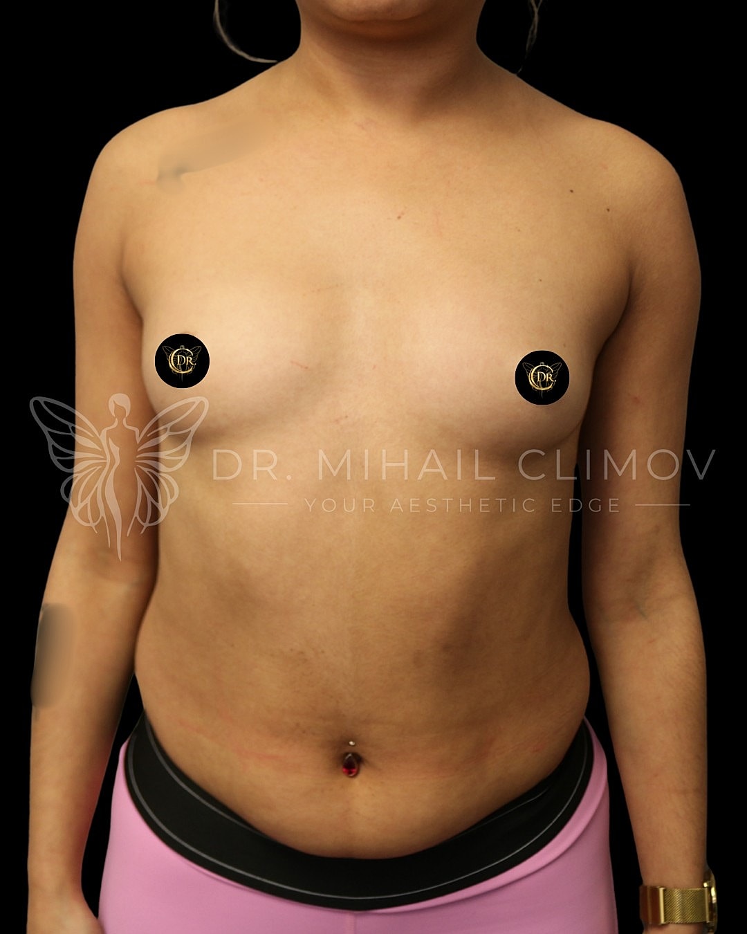 Case_3-11-26_before_front.png Before breast augmentation surgery – front view – Dr. Mihail Climov, Aesthetic Plastic Surgeon, Houston, TX
