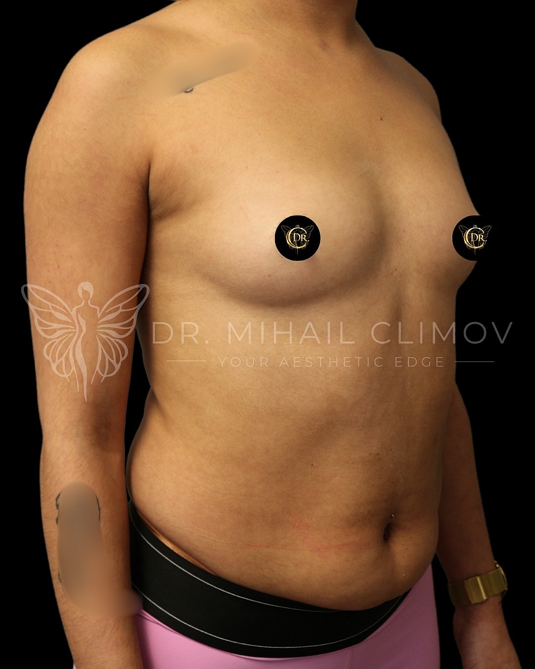 Case_3-11-26_Before_right_3_4.png Before breast augmentation surgery – right 3/4 angle view – Dr. Mihail Climov, Aesthetic Plastic Surgeon, Houston, TX