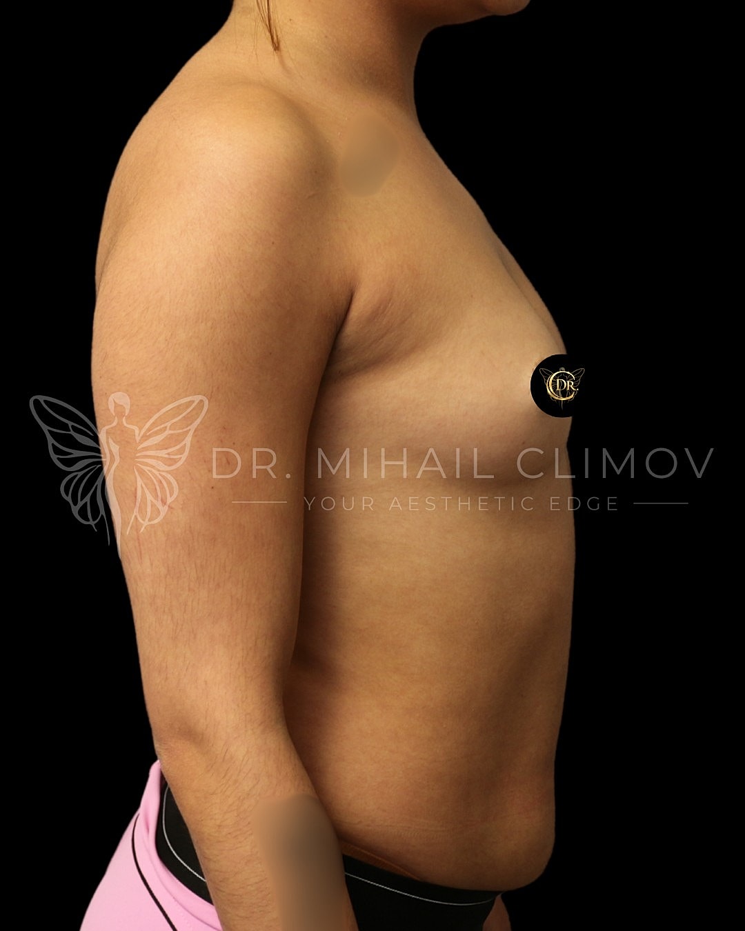Case_3-11-26_before_right.png Before breast augmentation surgery – right side profile view – Dr. Mihail Climov, Aesthetic Plastic Surgeon, Houston, TX