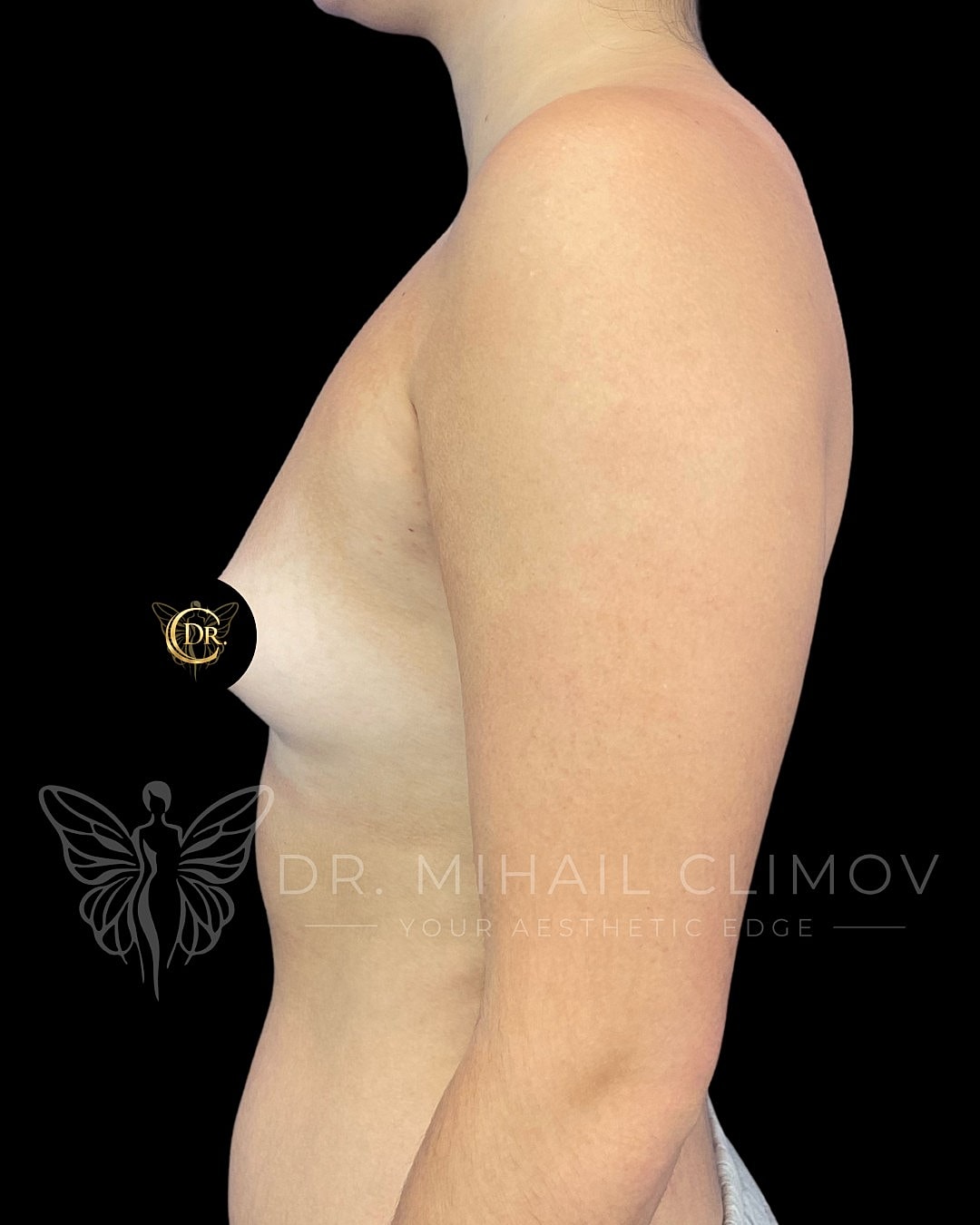 Breast Augmentation Before & After