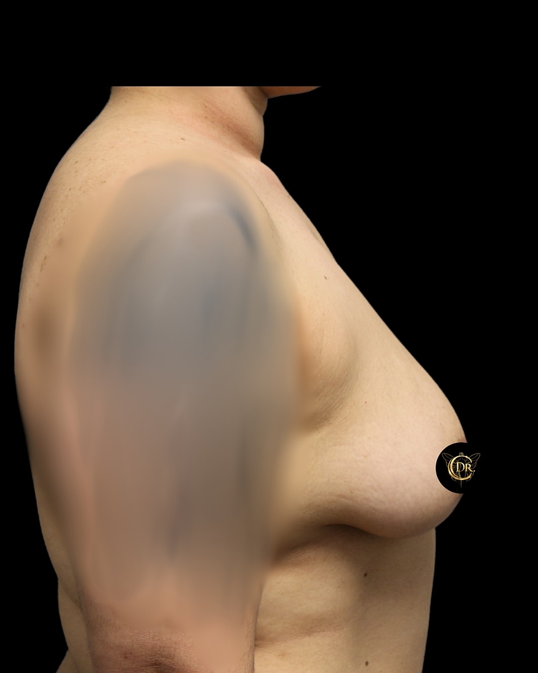 Breast Augmentation Before & After