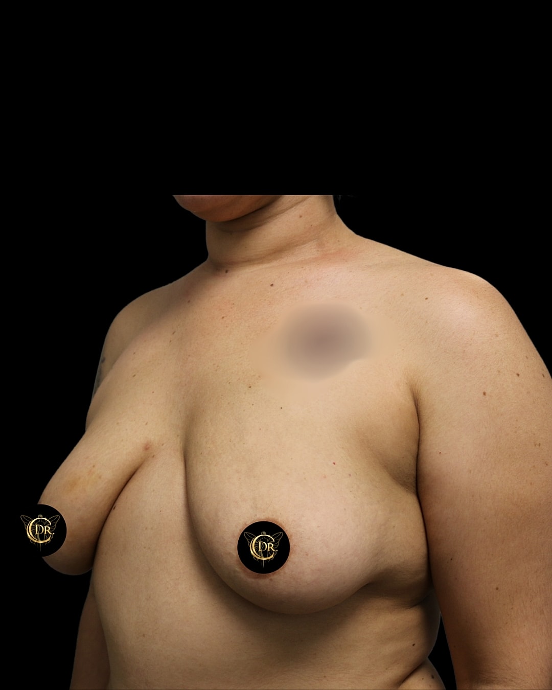 Breast Augmentation Before & After