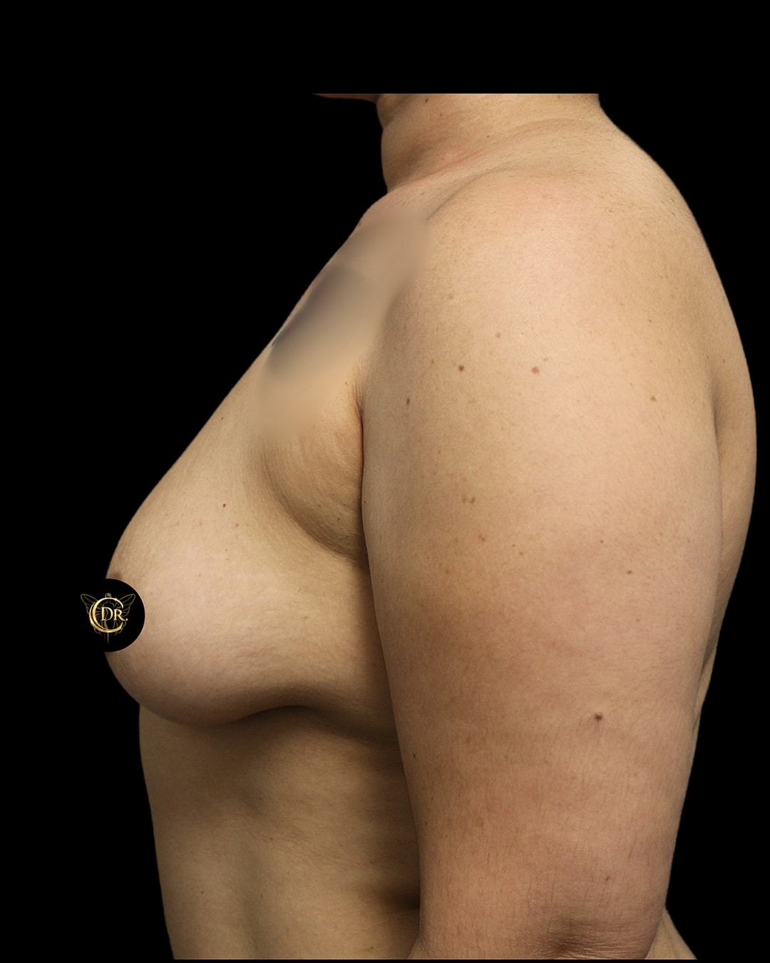 Breast Augmentation Before & After