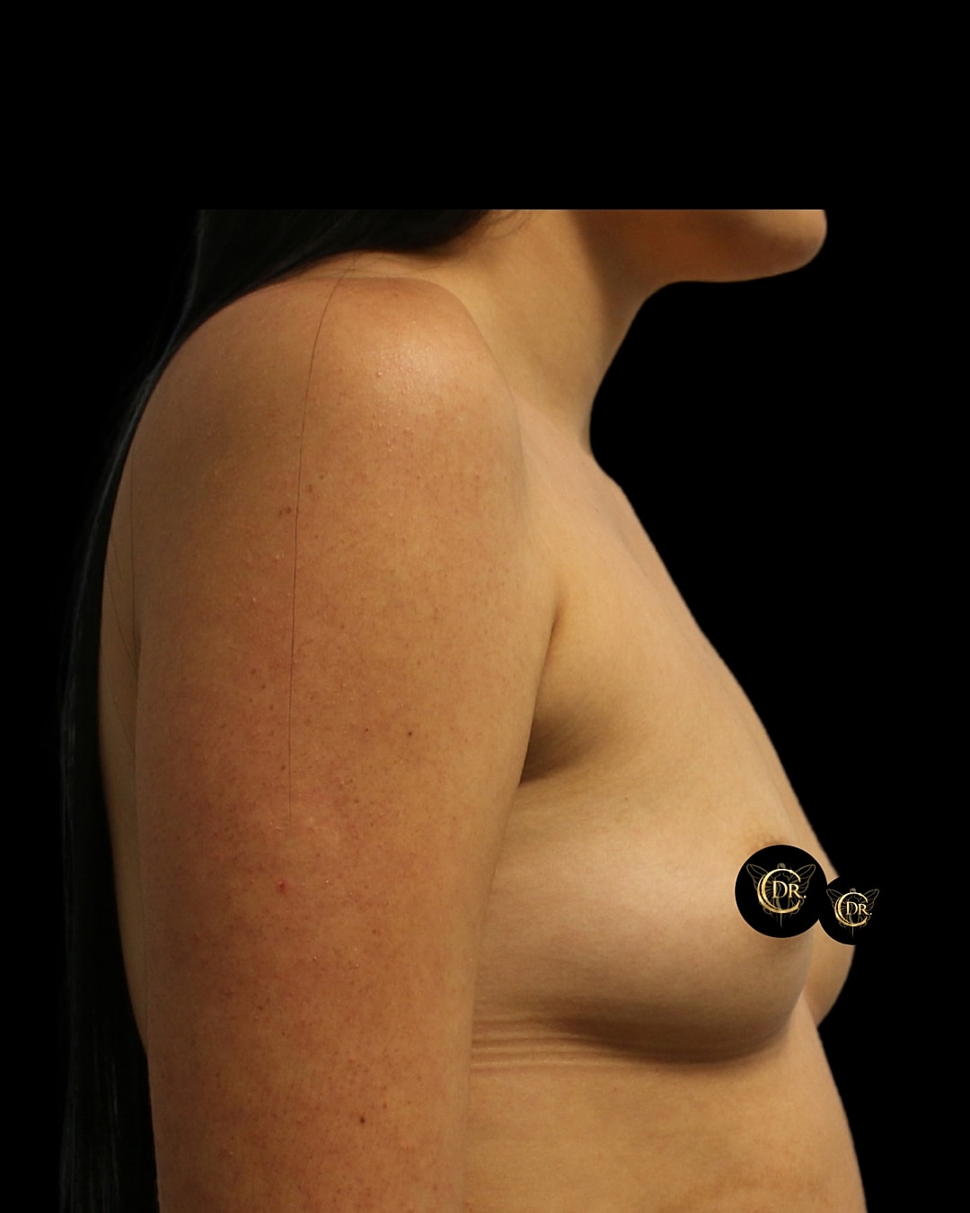 Breast Augmentation Before & After