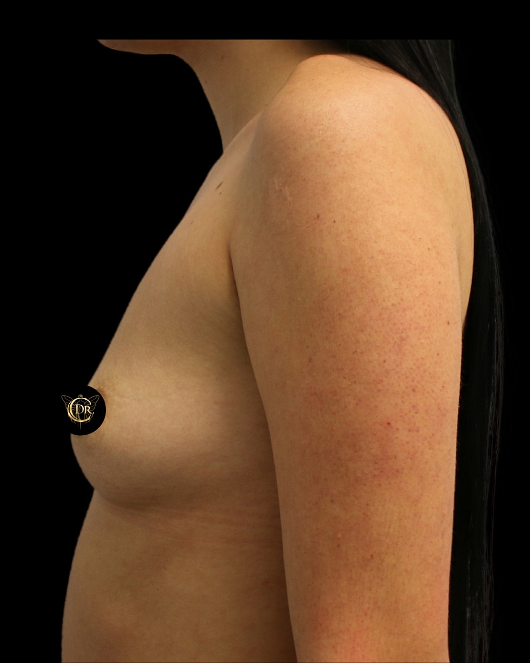 Breast Augmentation Before & After