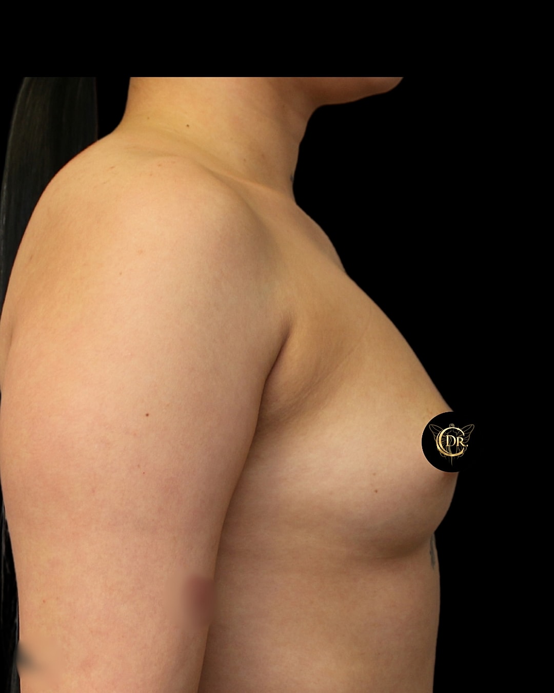 Breast Augmentation Before & After