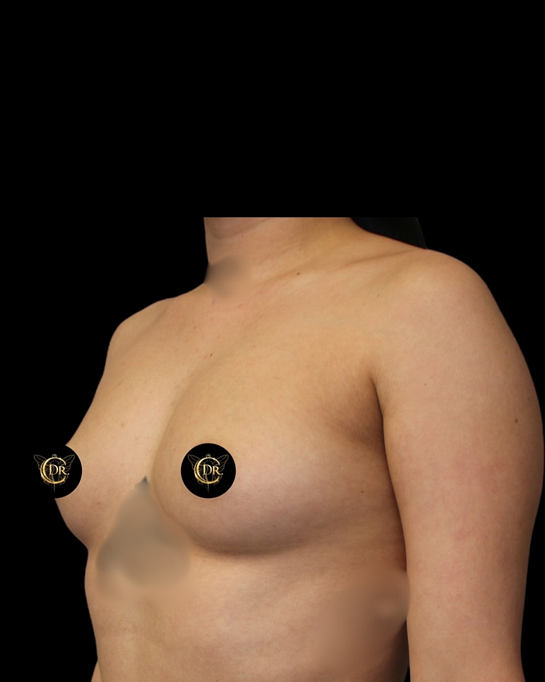 Breast Augmentation Before & After