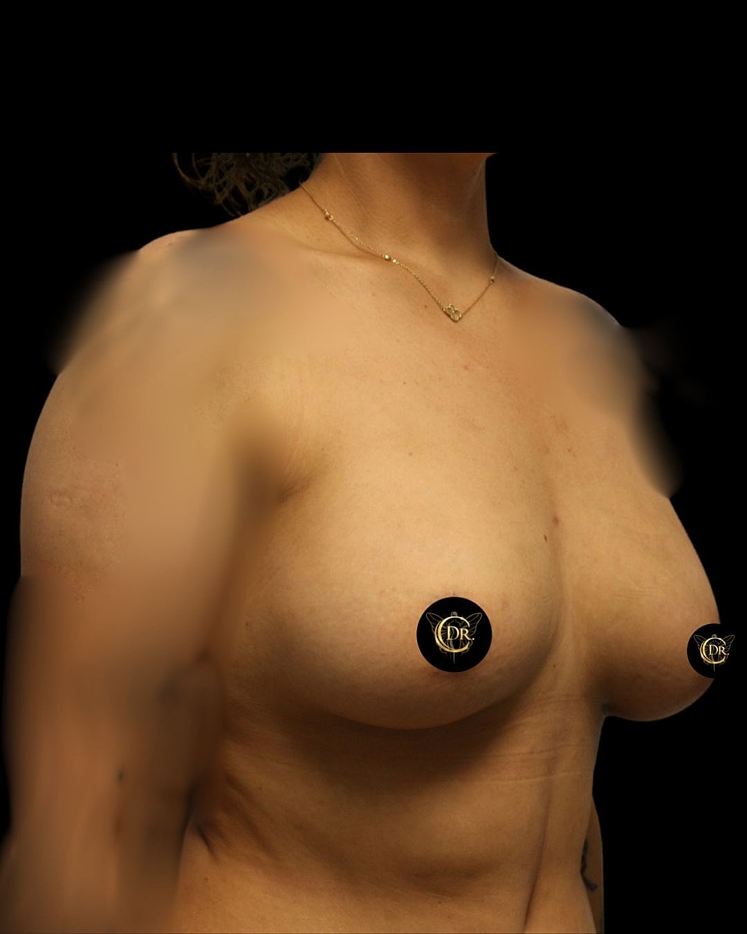 Breast Augmentation Before & After