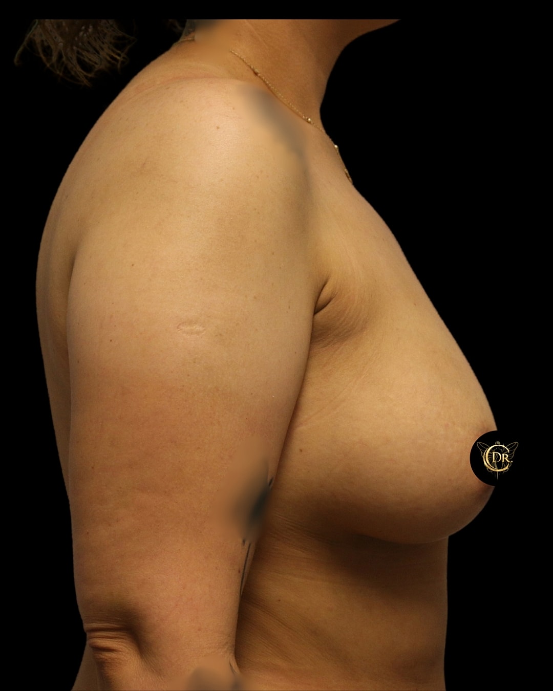 Breast Augmentation Before & After
