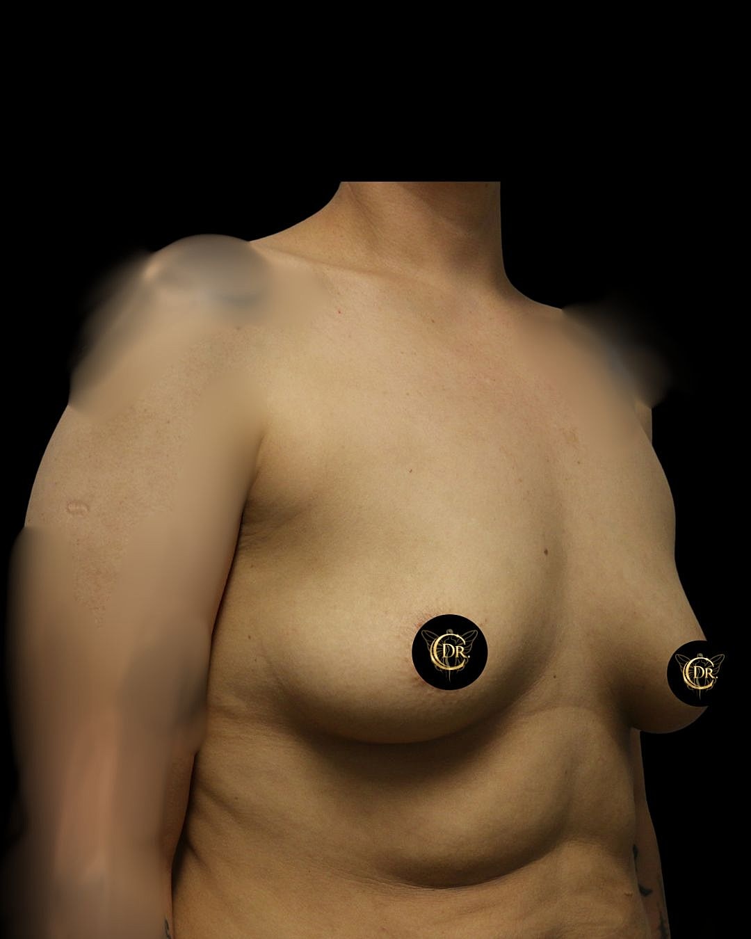 Breast Augmentation Before & After
