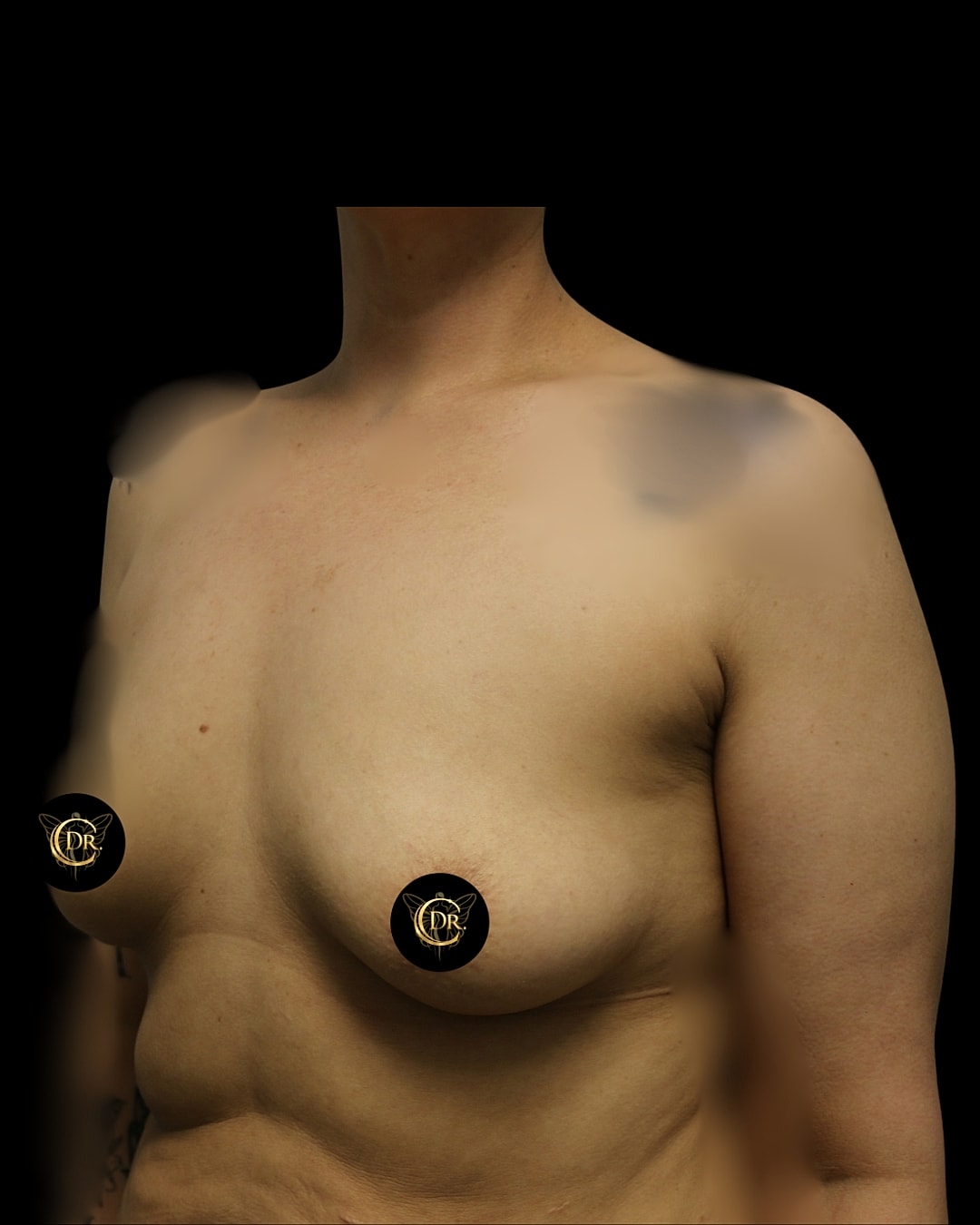 Breast Augmentation Before & After