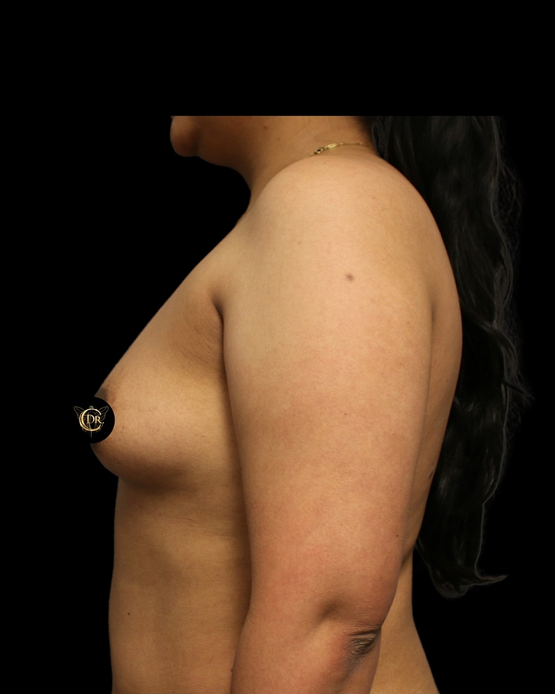 Breast Augmentation Before & After