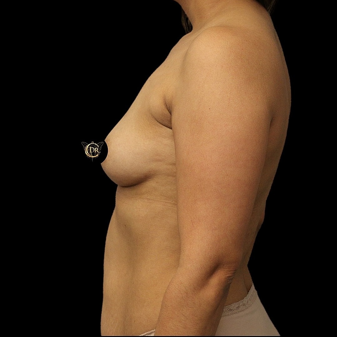 Breast Augmentation Before & After