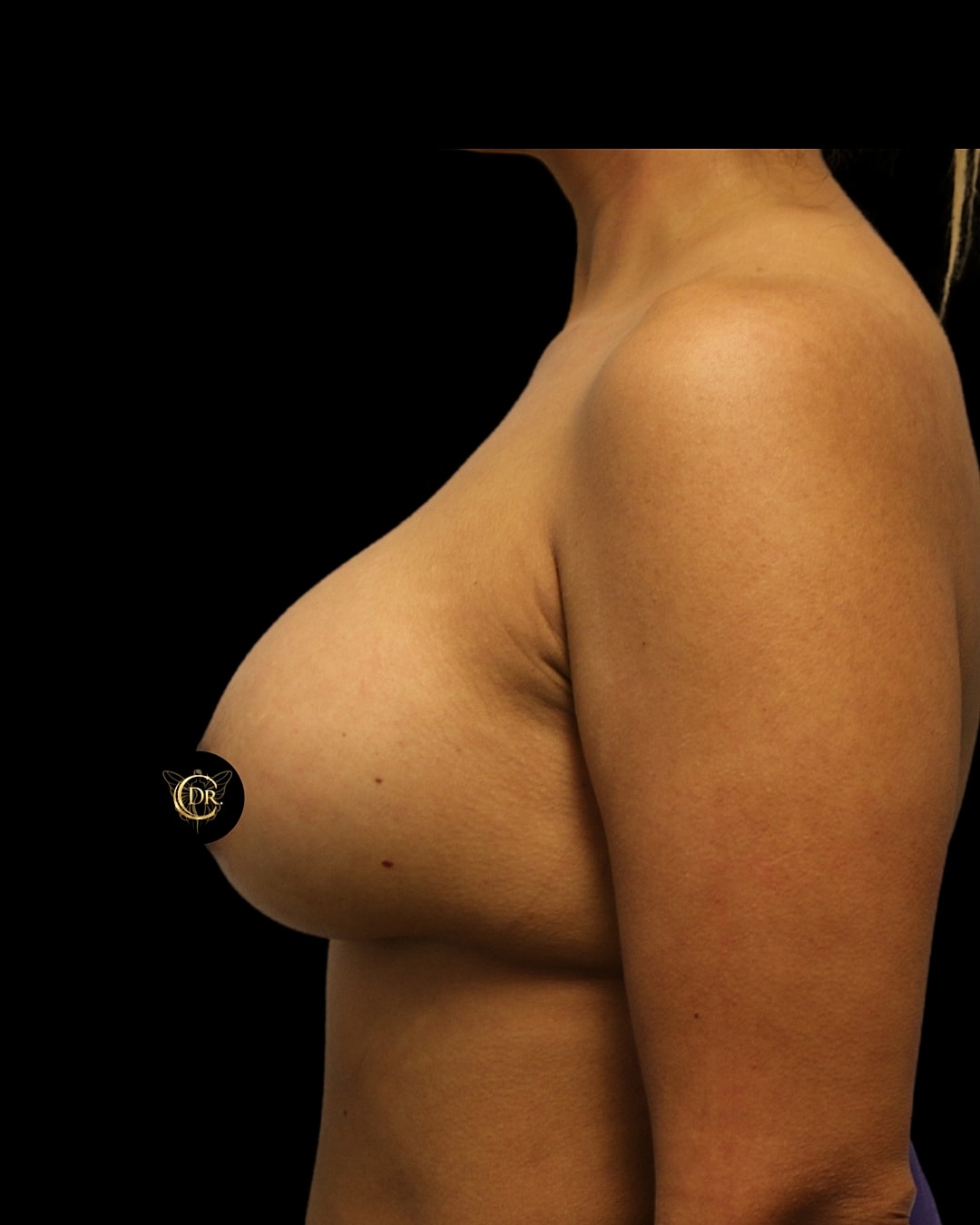Subfacial Breast Augmentation After Right Side, Case V88