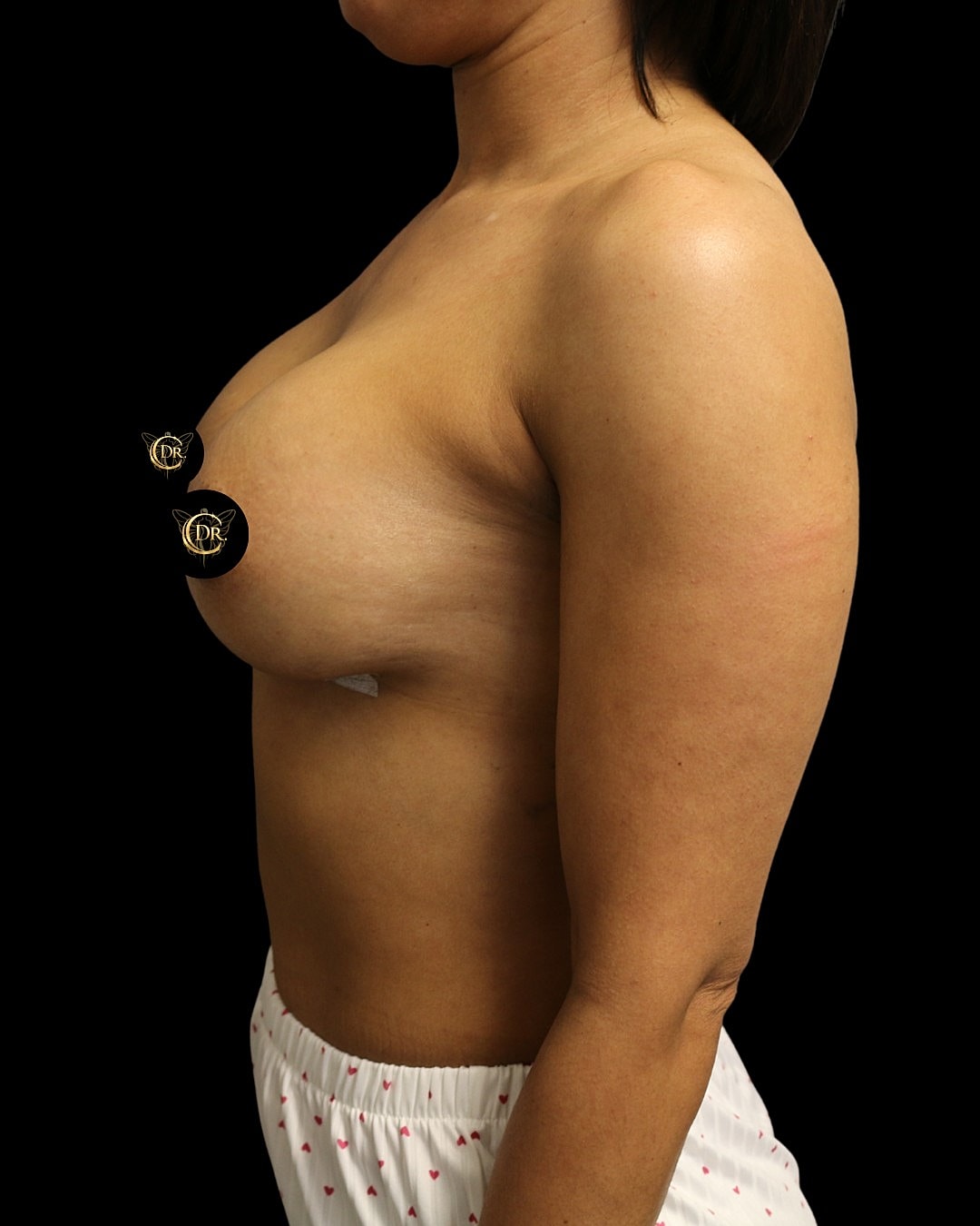 Breast Augmentation Before & After